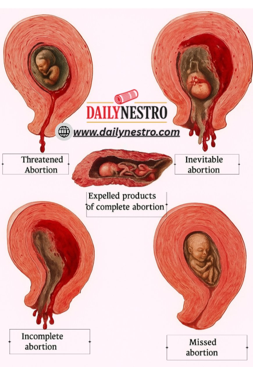 Understanding Spontaneous Abortion: A Guide to the Different Types