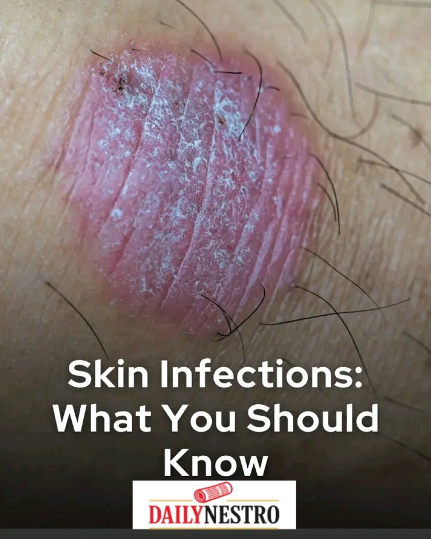 Do you know?? YOU CAN GET RID OF SKIN INFECTION IN TWO WEEKS.