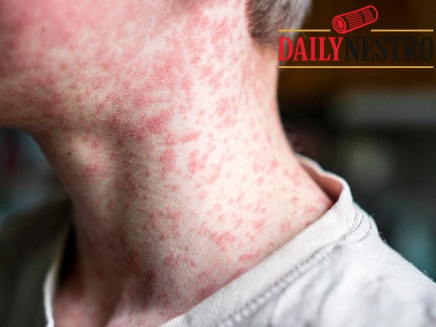 Over 150 Unvaccinated Students Quarantined After Measles Exposure in South Carolina Schools