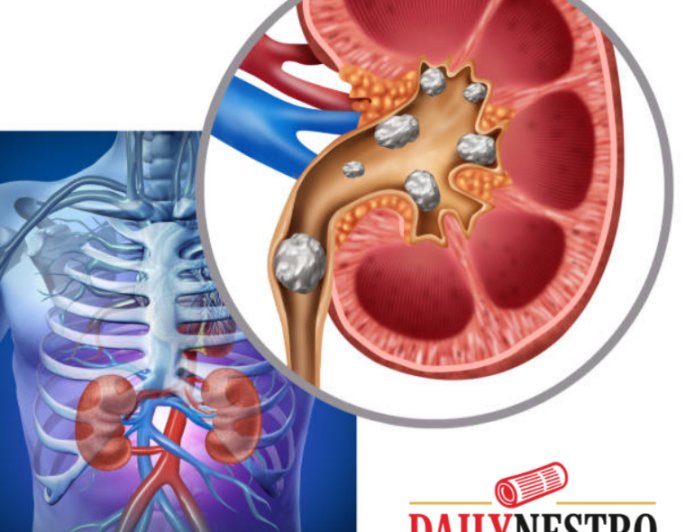 How Drinking Water Helps Prevent Kidney Stones Naturally