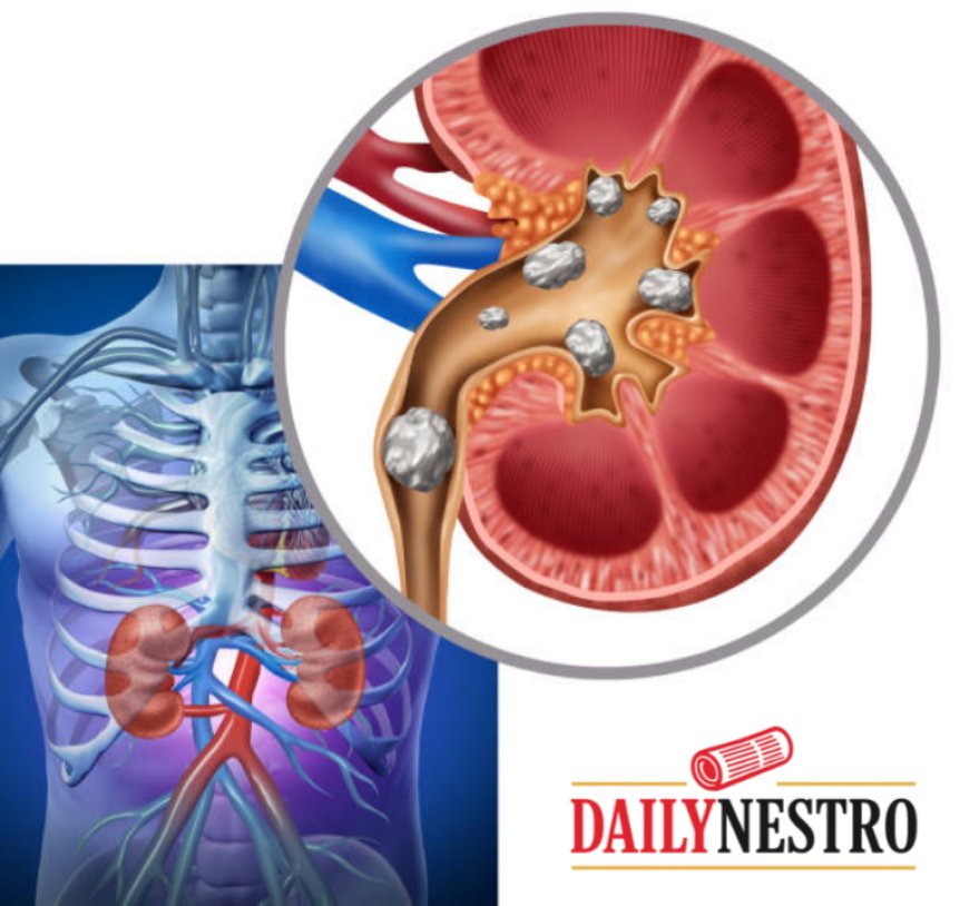 How Drinking Water Helps Prevent Kidney Stones Naturally